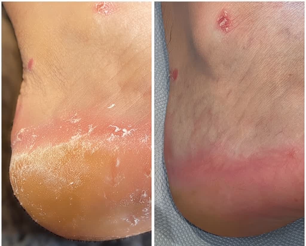 Medical pedicure result — foot before and after