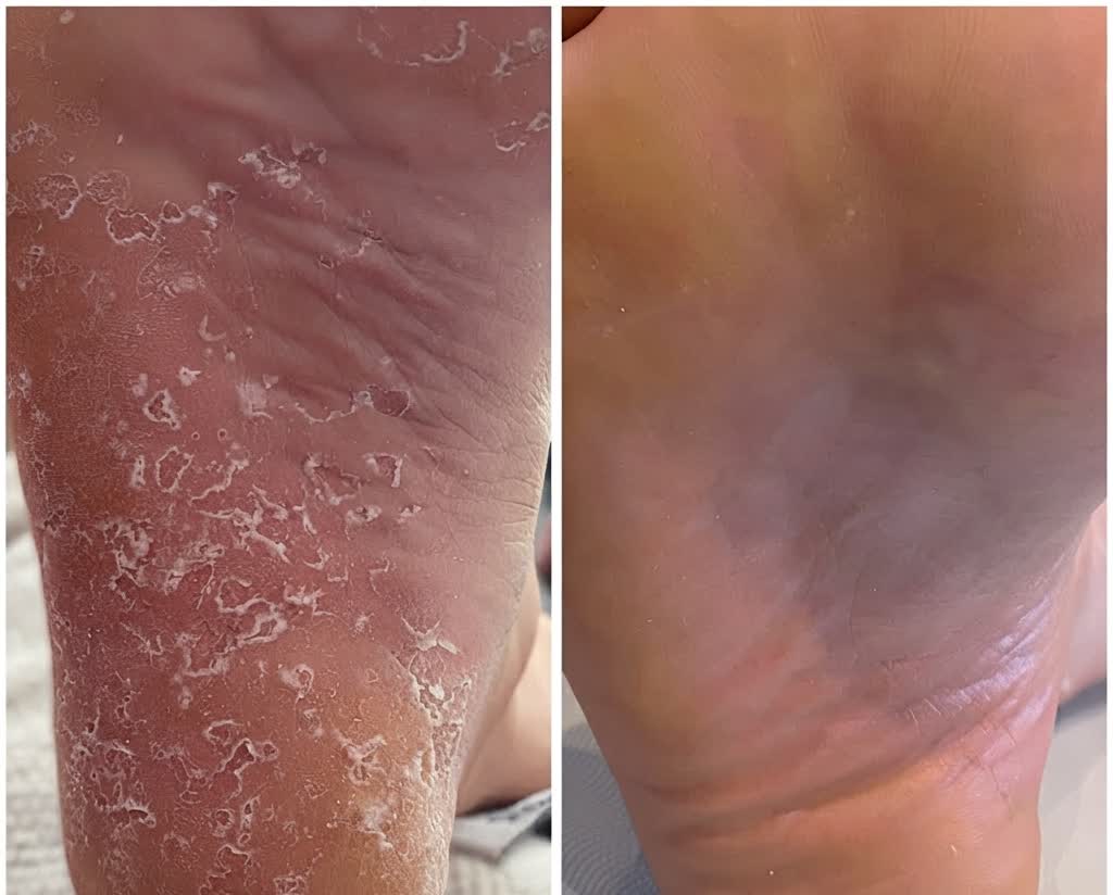 Medical pedicure result — heel before and after